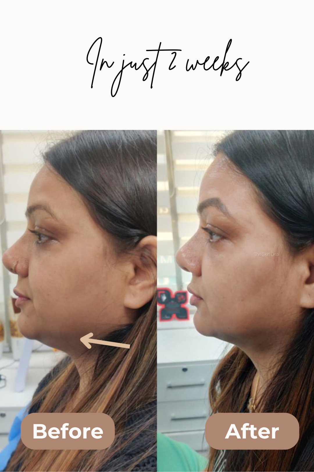 Poppy | Firming Shapewear for a Slimmed Face